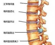 有這些癥狀要注意！是患了腰椎間盤(pán)突出